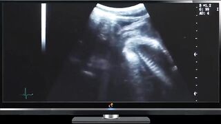 Ultrasound Preggo Slut Choked Gushed Cum Flooded Womb Destroyed