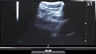 Ultrasound Preggo Slut Choked Gushed Cum Flooded Womb Destroyed